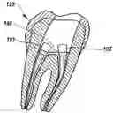 Fig. 01 - Kits and methods for chair-side coating of endodontic cones