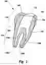 Fig. 04 - Kits and methods for chair-side coating of endodontic cones