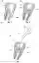 Fig. 06 - Kits and methods for chair-side coating of endodontic cones