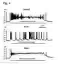 Fig. 05 - System for seizure suppression