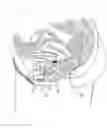 Fig. 01 - Incontinence treatment device
