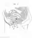 Fig. 03 - Incontinence treatment device