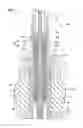 Fig. 06 - Treatment tool for endoscope