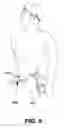 Fig. 05 - Retractor system for internal in-situ assembly during laparoscopic surgery