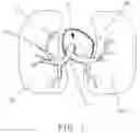 Fig. 02 - Pulmonary Artery Pressure Signals And Methods of Using