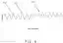 Fig. 09 - Pulmonary Artery Pressure Signals And Methods of Using