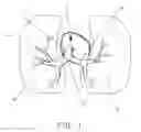 Fig. 02 - Pulmonary Artery Pressure Signals And Methods of Using