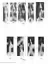 Fig. 02 - Therapeutic method for scolioses