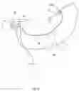 Fig. 14 - Method and device for irrigation of body cavities