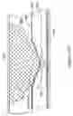 Fig. 16 - Perfusion and embolic protection