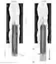 Fig. 14 - METHODS AND APPARATUS FOR TREATMENT OF VENOUS INSUFFICIENCY