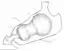 Fig. 01 - Intragastric balloon system and therapeutic processes and products