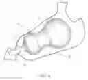 Fig. 04 - Intragastric balloon system and therapeutic processes and products