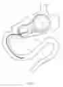 Fig. 05 - Intragastric balloon system and therapeutic processes and products