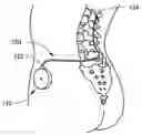 Fig. 01 - Catheter malfunction determinations using physiologic pressure
