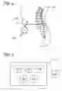 Fig. 04 - Catheter malfunction determinations using physiologic pressure