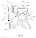 Fig. 07 - Expandable trans-septal sheath