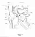 Fig. 08 - Expandable trans-septal sheath