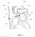 Fig. 09 - Expandable trans-septal sheath