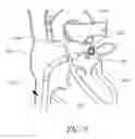 Fig. 10 - Expandable trans-septal sheath
