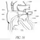 Fig. 11 - Expandable trans-septal sheath