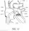Fig. 12 - Expandable trans-septal sheath