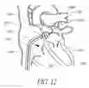 Fig. 13 - Expandable trans-septal sheath