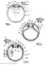 Fig. 02 - Pouch-Equipped Intragastric Balloon