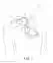 Fig. 02 - Intracardiac polarization signal stabilization