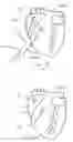 Fig. 10 - CARDIAC STIMULATION APPARATUS
