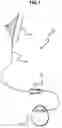 Fig. 02 - Lead anchor for implantable stimulation devices