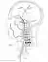 Fig. 02 - Intracranial stent and method of use