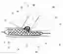 Fig. 01 - Bifurcation stent and balloon assemblies