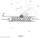 Fig. 05 - Bifurcation stent and balloon assemblies