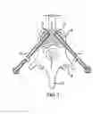 Fig. 02 - Devices for multipoint emplacement in a body part and methods of use of such devices