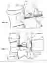 Fig. 12 - Lateral spinous process spacer