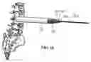 Fig. 13 - Lateral spinous process spacer