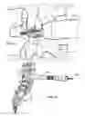 Fig. 16 - Lateral spinous process spacer