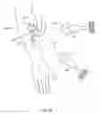 Fig. 53 - Orthovoltage radiosurgery