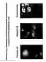 Fig. 45 - Skin equivalents derived from umbilical cord mesenchymal stem/progenitor cells and umbilical cord epithelial stem/progenitor cells