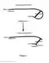 Fig. 02 - Use of Hyaluronidase in Combination with Plasmin for the Induction of Posterior Vitreous Detachment