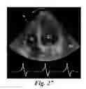 Fig. 28 - SYSTEM AND METHOD TO MEASURE CARDIAC EJECTION FRACTION