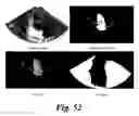 Fig. 46 - SYSTEM AND METHOD TO MEASURE CARDIAC EJECTION FRACTION