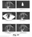 Fig. 48 - SYSTEM AND METHOD TO MEASURE CARDIAC EJECTION FRACTION