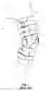 Fig. 02 - Cable-based orthopedic bracing system