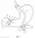 Fig. 02 - INTRALUMINAL AND TRANSLUMINAL DEVICE AND METHOD OF VISUALIZATION AND THERAPEUTIC INTERVENTION