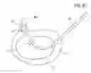 Fig. 06 - Radio Frequency Ablation Electrode for Selected Tissue Removal