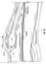 Fig. 10 - Method and apparatus for surgical dissection