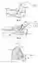Fig. 23 - Method and apparatus for surgical dissection