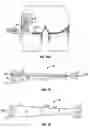Fig. 40 - Method and apparatus for surgical dissection